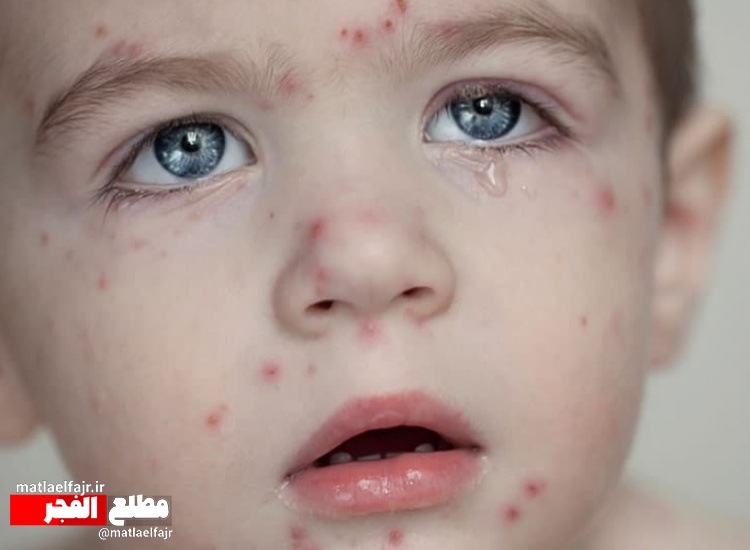 پیام اگاهسازی شبکه بهداشت گیلانغرب در مورد "آبله مرغان"