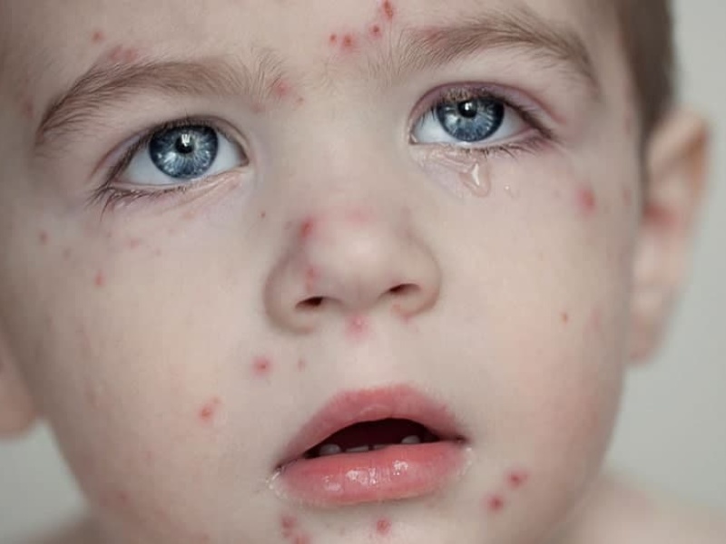 پیام اگاهسازی شبکه بهداشت گیلانغرب در مورد "آبله مرغان"